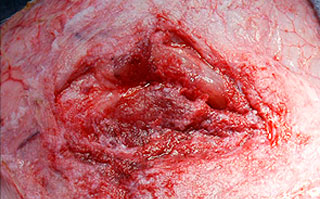 control of surgical wounds